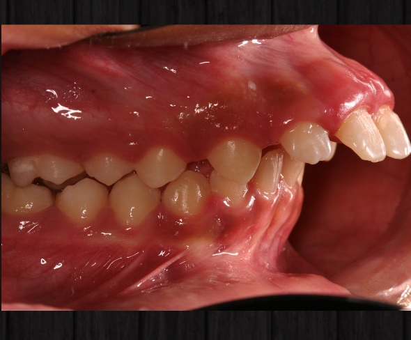 ortodontia+retrognatismo